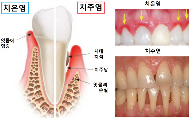 치아쪼개짐, 바로 치과 안가면 신경치료까지 갑니다 관련 이미지 8