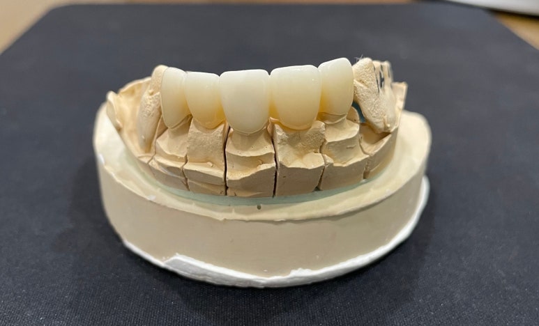 앞니브릿지, 치료기간 앞니 없이 생활해야하나요? 관련 이미지 3