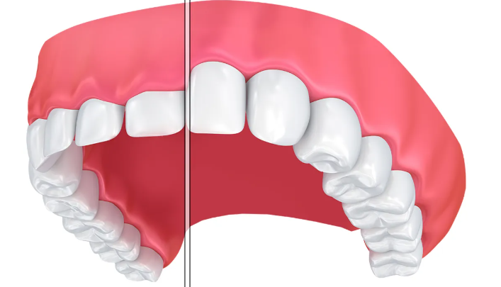 잇몸성형가격, 의사가 알려주는 2가지 확인사항 관련 이미지 2
