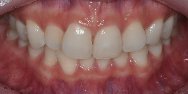 라미네이트 vs 레진 차이점 장단점 완벽 비교 관련 이미지 7