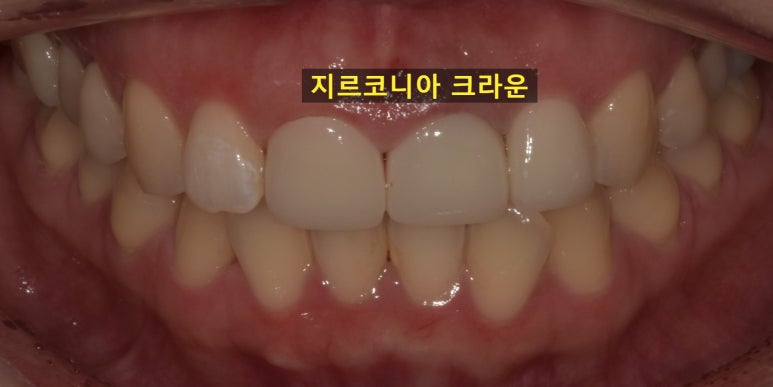 올세라믹vs지르코니아 크라운 비교분석과 비용까지 관련 이미지 10