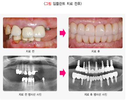 Dental Implant Re-treatment in Seocho-gu: Where You Have It Done the First Time Makes All the Difference image 3