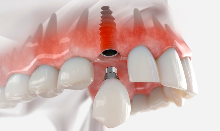 원데이인플란트, 누구나 다 할 수 있다? <내게 맞는 치료법 찾기> 관련 이미지 1