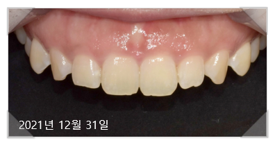 잇몸수술비용? 이 글로 종결합니다. 관련 이미지 3