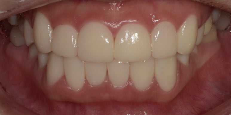 교정없이 라미네이트로 치아배열 개선? 앞니 12개 케이스 공개 관련 이미지 4