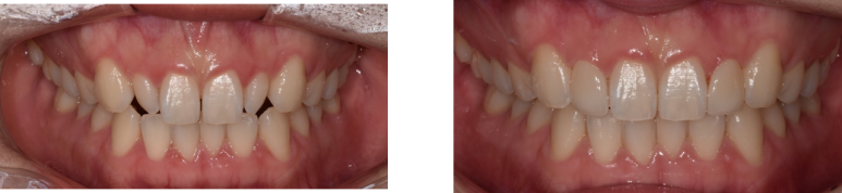 무삭제라미네이트, 아무나 못 하는 이유 관련 이미지 2