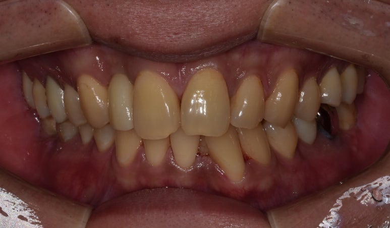 20대임플란트 수명? 평생 못쓸수도 있습니다. 관련 이미지 4