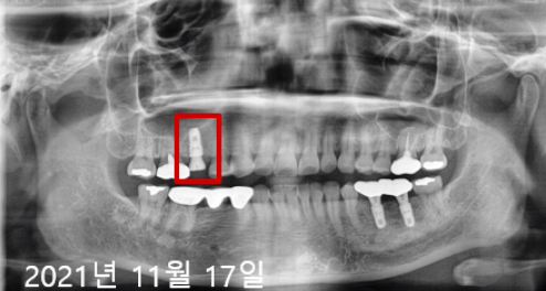 네비게이션인플란트가격? 이 글로 종결합니다. 관련 이미지 4