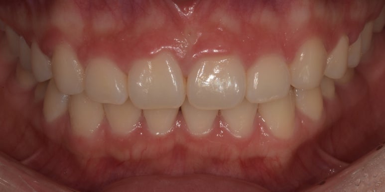 잇몸비대칭, 30분만에 개선하는 방법과 최근 치료사례 공유 관련 이미지 6