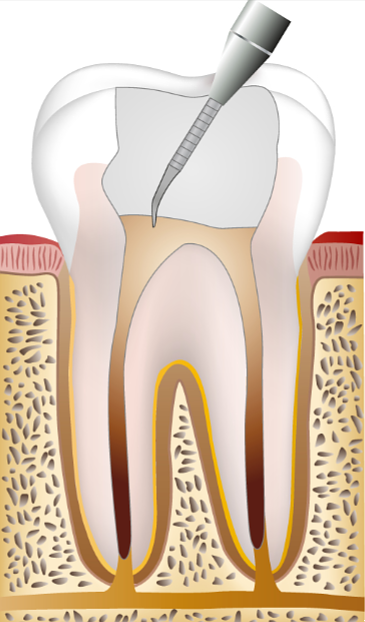 신경치료고통? 통증을 줄이는 방법은 바로 OO입니다. 관련 이미지 10
