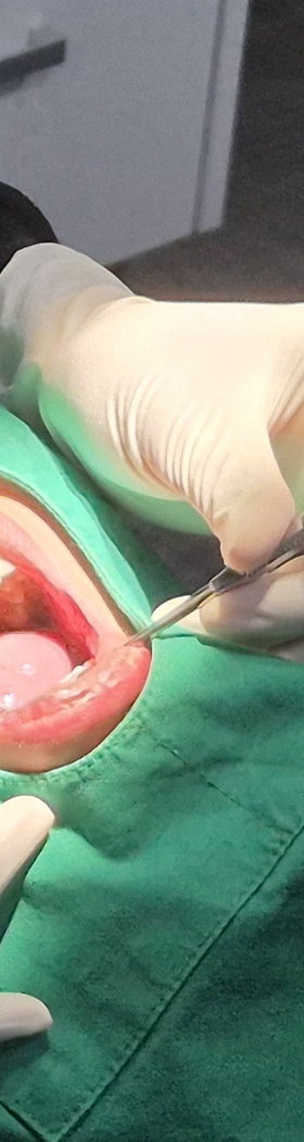 한티역치과 임플란트, 뼈이식 꼭 해야 할까? <의사 답변> 관련 이미지 14