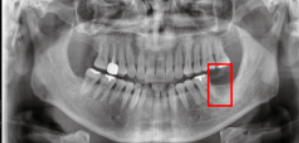 임플란트후붓기? 걱정하시던 환자분 치료 과정 관련 이미지 2