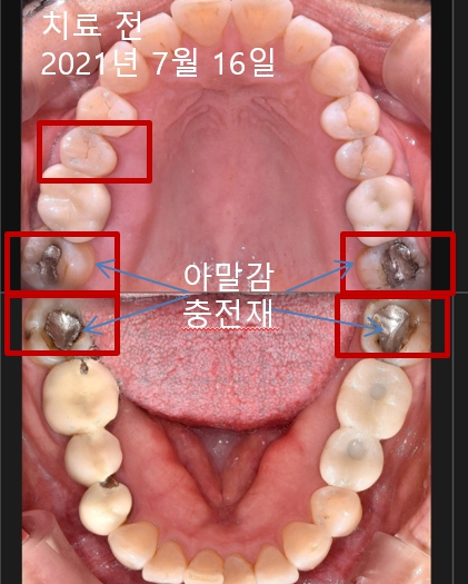 국산임플란트가격? 이 글로 종결합니다. 관련 이미지 3