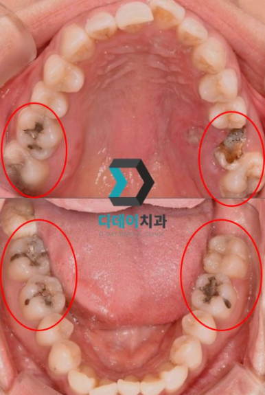 어금니가시려요, 원인별 해결법 의사가 알려드립니다 관련 이미지 7