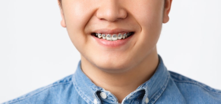 교정? 라미네이트? 앞니배열 바꾸려면 뭐가 더 좋을까? 관련 이미지 4