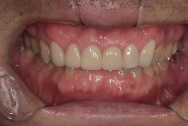 라미네이트 전후사진과 치료비용까지 숨김없이 알려드립니다. 관련 이미지 9