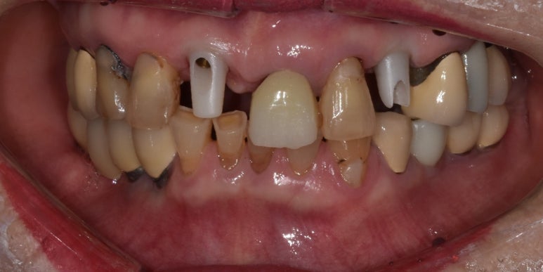 임플란트깨짐, 단순한 문제가 아닐 수 있습니다. 관련 이미지 4