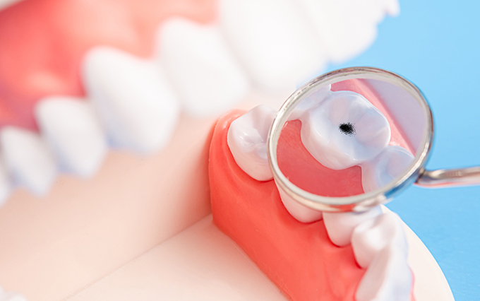 충치치료비용 걱정인데.. 치료 안해도 되는 충치도 있다구요? 관련 이미지 1