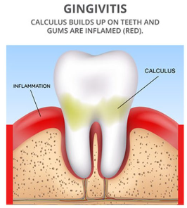 잇몸 부으면 치석 때문? 치아 흔들림의 이유 관련 이미지 4