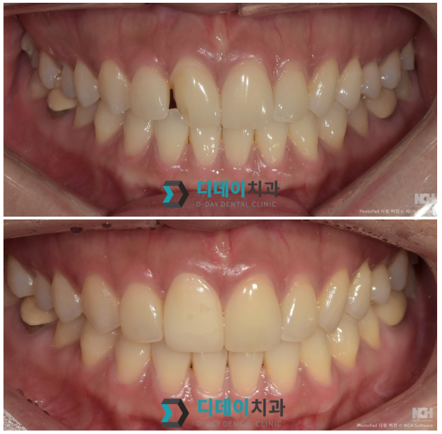 대치역치과, 라미네이트 잘하는 곳 찾으세요? 2가지면 됩니다 관련 이미지 6