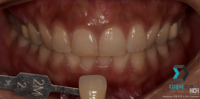 치아미백치료가격만 보고 가면 안되는 이유 2가지 관련 이미지 7