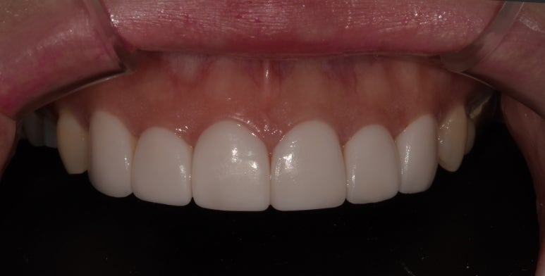 라미네이트과정, 어떻게 진행되는지 궁금하다면? 관련 이미지 6