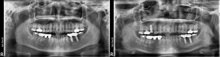 임플란트기간과 내원횟수는 얼마나 될까? 관련 이미지 7