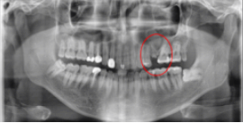 임플란트교체? 걱정되시는분들만 보세요. 관련 이미지 2