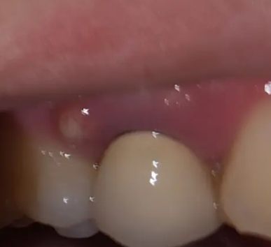 어금니잇몸물집, 방치하면 안 되는 이유 의사가 직접 설명합니다 관련 이미지 4