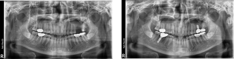 임플란트기간과 내원횟수는 얼마나 될까? 관련 이미지 4
