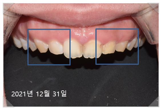 잇몸수술비용? 이 글로 종결합니다. 관련 이미지 6