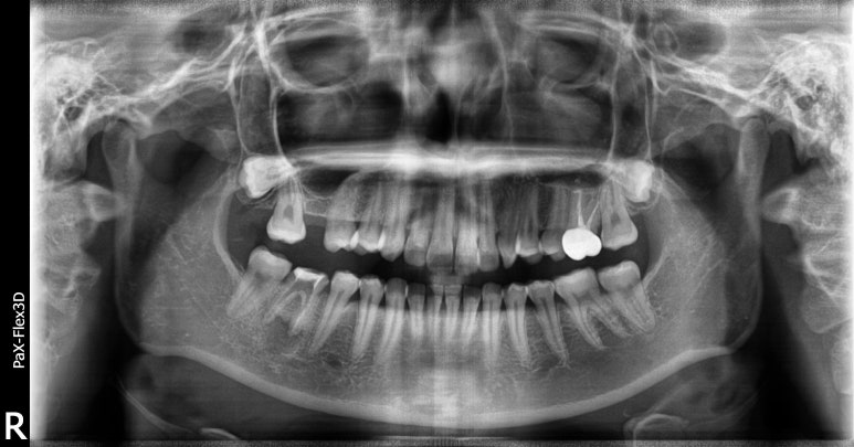 젊은나이임플란트? 젊을수록 더 빨리 심어야합니다. 관련 이미지 7