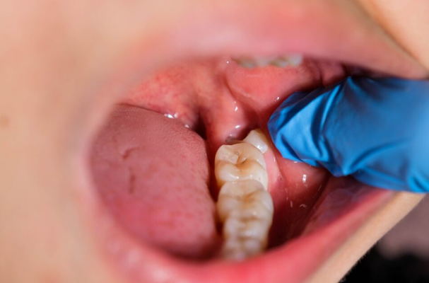 강남역치아교정, 지금 시작하지않으면 비용이 더 들 수 있습니다 관련 이미지 4