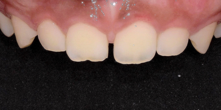 라미네이트 전후 비교, 주의사항, 비용까지 총정리 관련 이미지 1