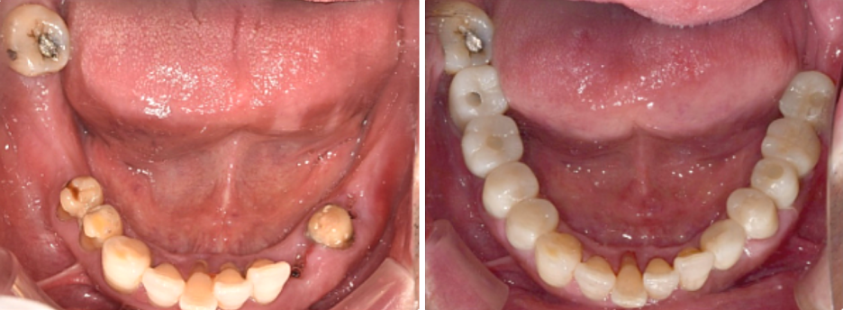 임플란트가격, 적절한 비용은 얼마? 관련 이미지 3