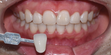 승무원 치아미백, 그 비결이 궁금하다면? 관련 이미지 4