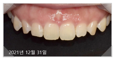잇몸수술비용? 이 글로 종결합니다. 관련 이미지 2