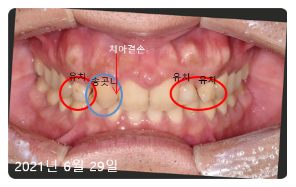 네비게이션임플란트비용? 대표원장이 솔직하게 공개합니다. 관련 이미지 1