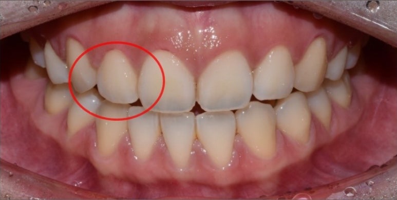 잇몸성형가격? 비용, 주의사항, 치료 후기 공개 관련 이미지 6