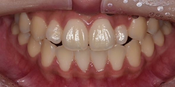 치은절제술/성형술? 잇몸이 치아를 덮고 있어 고민인 분만 관련 이미지 9