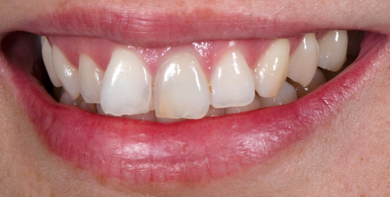 무삭제라미네이트 누구나 다 된다? 속지마세요. 관련 이미지 2