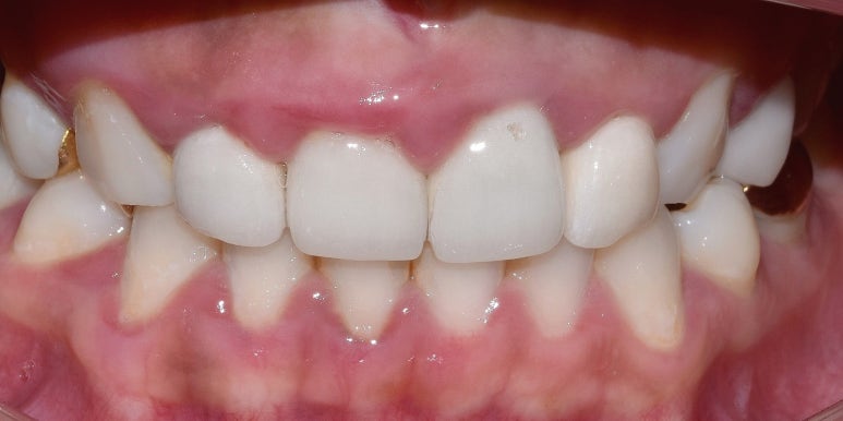 라미네이트올세라믹, 차이점과 치료사례까지 모두 공유합니다. 관련 이미지 9