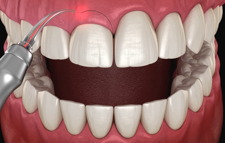 치은절제술/성형술? 잇몸이 치아를 덮고 있어 고민인 분만 관련 이미지 2