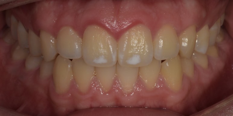 남자라미네이트, 최신 치료사례와 비용까지 전부 공개합니다. 관련 이미지 9