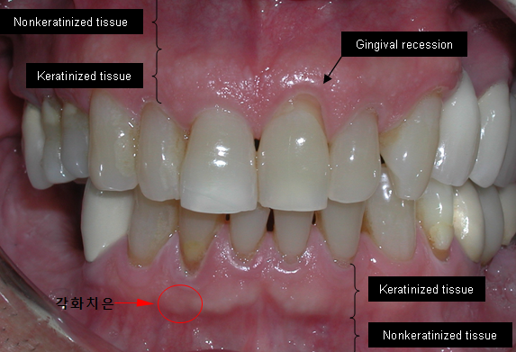 각화치은, 잇몸 건강의 핵심은 이것에 달려있습니다 관련 이미지 2