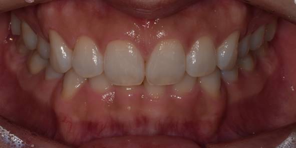 잇몸성형후기, 사례가 없어 고민하셨던 분만 관련 이미지 4