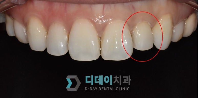 작은이빨, 왜소치? 치아 크기를 키우고 싶은 분만 <필독> 관련 이미지 5