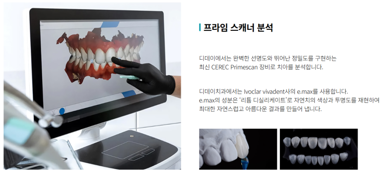 송곳니라미네이트, 웃을 때 유독 신경 쓰였다면 읽어보세요 관련 이미지 6