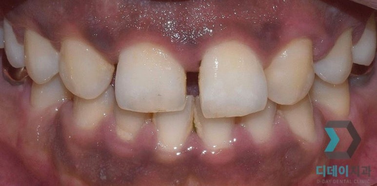 잇몸이까매요... 잇몸착색 치료방법, 사례, 비용 대공개 관련 이미지 1