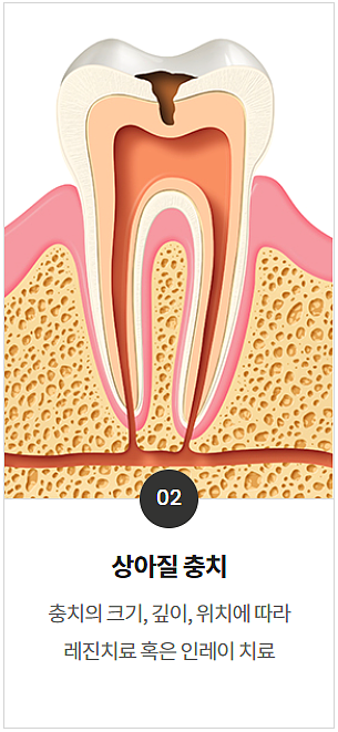 충치치료 기간, 과정, 비용까지 전문의가 알려드립니다. 관련 이미지 8